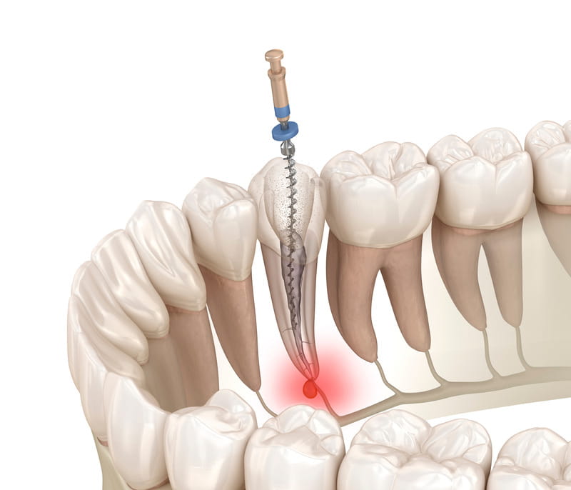 Endodontie in Mainz einfach erklärt: Was bei einer Wurzelbehandlung wirklich passiert