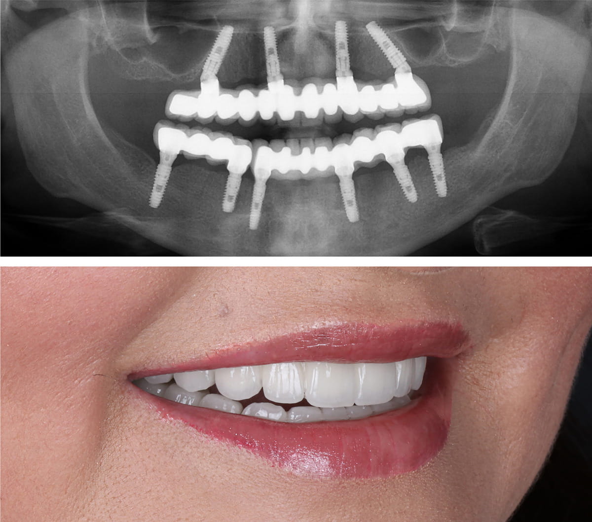 Feste Zähne an einem Tag auf 4 oder 6 Implantaten in Mainz bei Zahnarzt Dr. Tomalla, DentalGut
