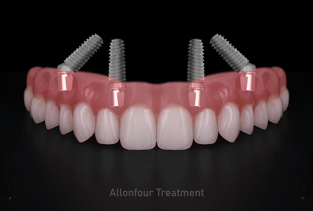 Feste Zähne auf 4 Implantaten bei DentalGut in Mainz - Ideal für Angstpatienten