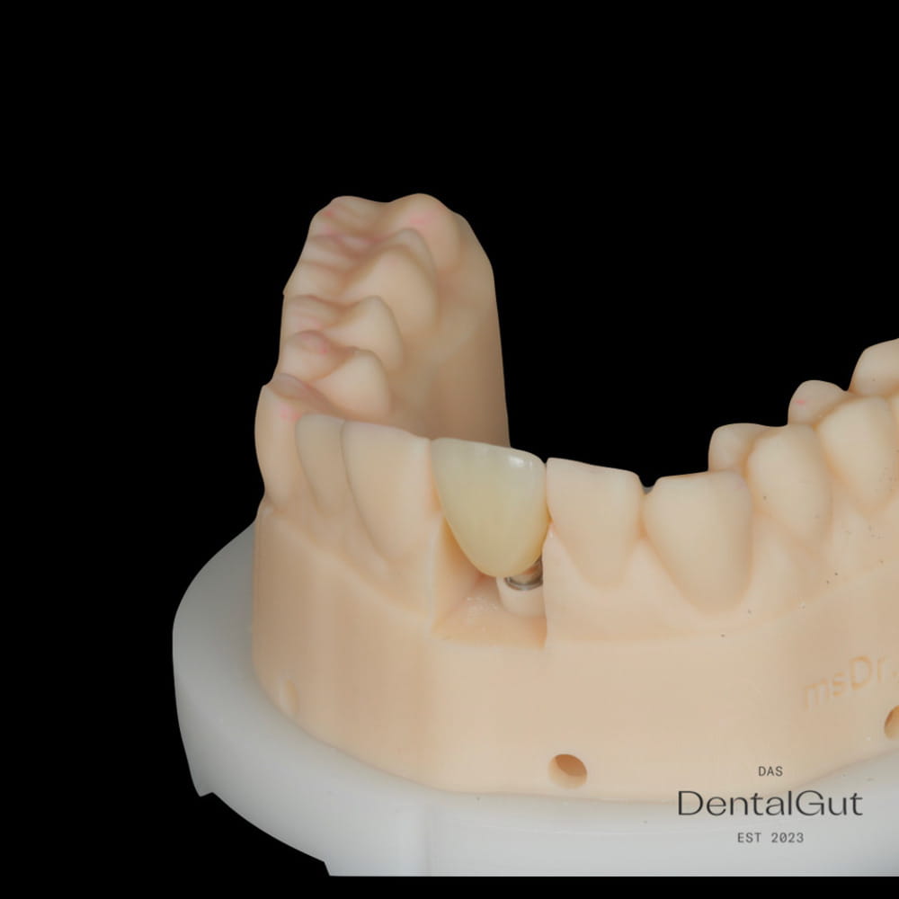 Meisterhafte Prothetik als Schlüssel zum Erfolg bei DentalGut Mainz - Sofortimplantation - Zahnimplantat