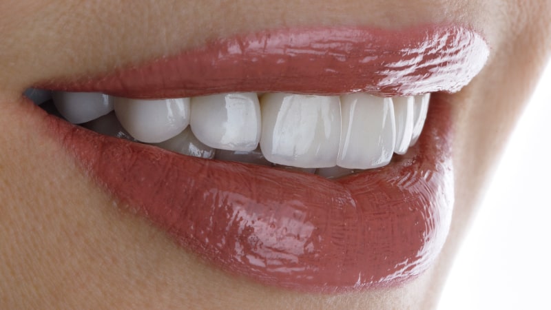 Veneers in Mainz für Ihren perfekten Look bei DentalGut