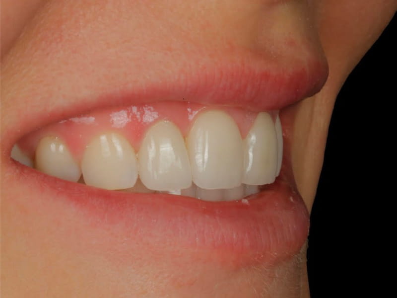 Vorteile von Veneers bei DentalGut in Mainz