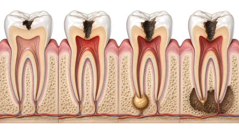 Warum sich ein Zahnnerv entzündet – die häufigsten Auslöser. Endodontie Mainz